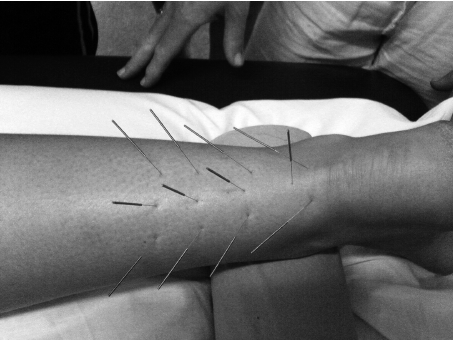 Herringbone acupuncture for achilles pain
