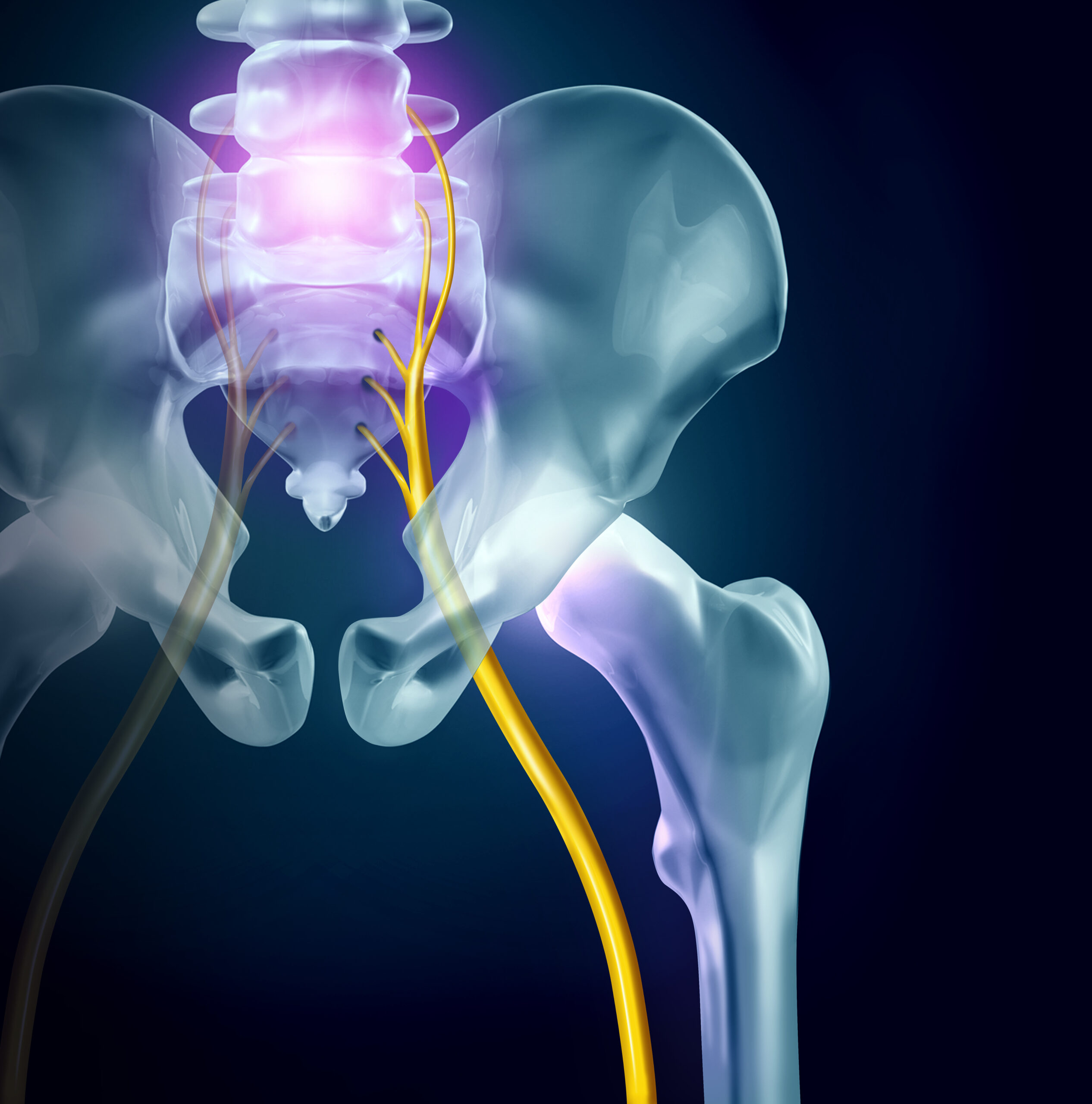 Degenerative disc disease in humans by Emily Catford Therapies